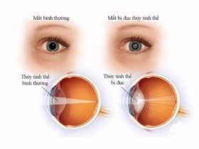 Tiểu đường 14 năm có gây biến chứng mờ cả 2 mắt không?